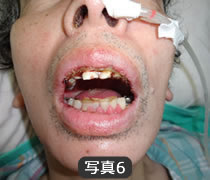 がん治療に伴う口腔の問題点（写真6）