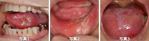 がん治療に伴う口腔の問題点（写真1～3）