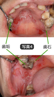 がん治療に伴う口腔の問題点（写真4）