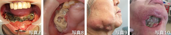 がん治療に伴う口腔の問題点（写真7～10）